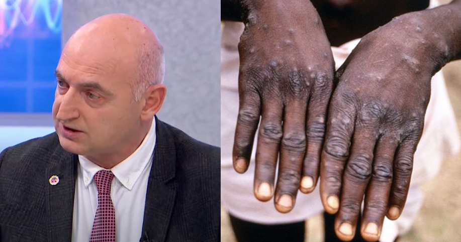 ვინც 1980 წლამდე დაიბადეთ… – რა ინფორმაცია გახდა ცნობილი “მაიმუნის ყვავილთან” დაკავშირებით