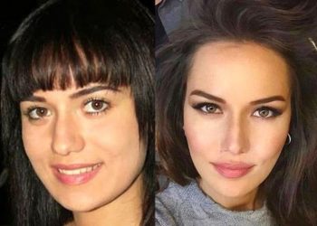 თურქული სერიალების მომხიბვლელი ვარსკვლავები პლასტიკურ ოპერაციებამდე და ახლა