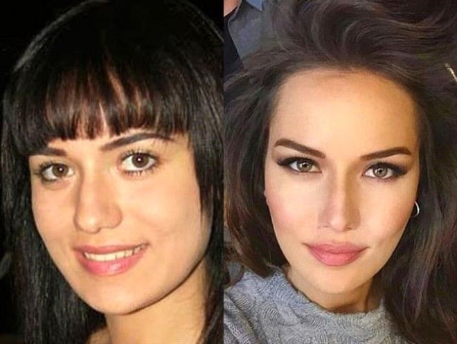 თურქული სერიალების მომხიბვლელი ვარსკვლავები პლასტიკურ ოპერაციებამდე და ახლა