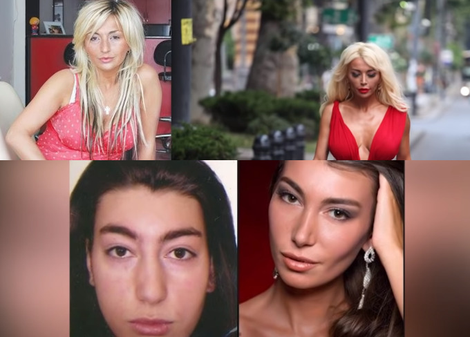 15 ცნობილი ქართველი სელებრითი, რომელთაც პლასტიკურ ქირურგიას მიმართეს – ადრე და ახლა (ფოტოგალერეა)