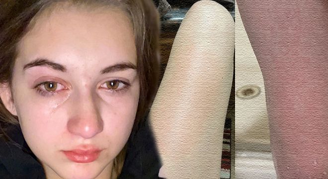 უკვე 1 წელია წყალი არ დამილევია, წყალთან ყოველი შეხების შემდეგ ასეთი რამ მემართება