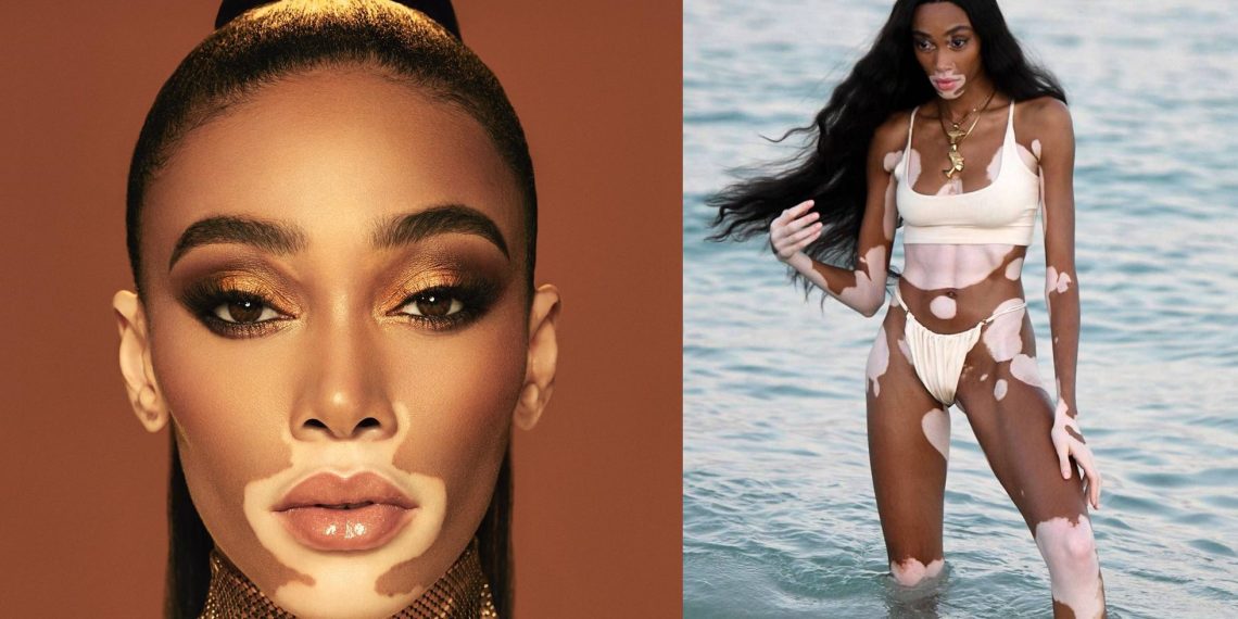 როგორ გამოიყურება უიშვიათესი დაავადების-ვიტილიგოს მქონე ლამაზმანი, რომელიც მსოფლიოს ერთ-ერთ ულამაზეს მოდელად მიიჩნევა