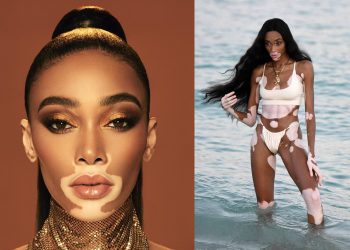 როგორ გამოიყურება უიშვიათესი დაავადების-ვიტილიგოს მქონე ლამაზმანი, რომელიც მსოფლიოს ერთ-ერთ ულამაზეს მოდელად მიიჩნევა