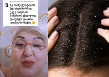 როგორ შევაჩეროთ თმის ცვენა და როგორ მოვიშოროთ ქერტლი – ნახეთ 2 სასარგებლო და აქამდე ბევრისთვის უცნობი მეთოდი