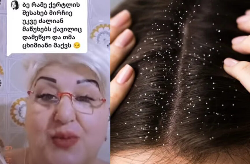 როგორ შევაჩეროთ თმის ცვენა და როგორ მოვიშოროთ ქერტლი – ნახეთ 2 სასარგებლო და აქამდე ბევრისთვის უცნობი მეთოდი