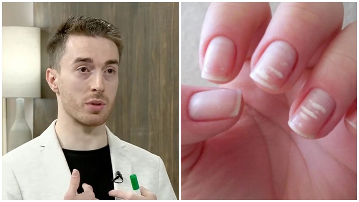 ადვილად დაღლა, ჭრილობის რთულად შეხორცება, თეთრი ლაქები ფრჩხილებზე – რა პრობლემებზე მეტყველებენ ეს ნიშნები