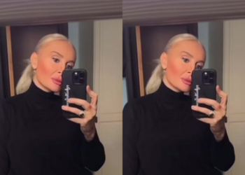 ვიდეო : როგორ გამოიყურება ნანუკა ჟორჟოლიანი სახეზე ფტოზის დაფიქისრებისთვის ძაფების ჩასმის შემდეგ