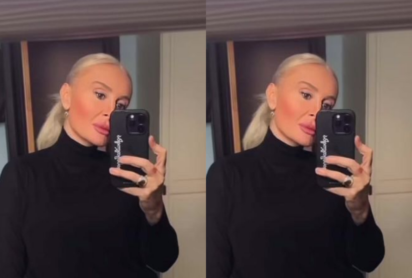 ვიდეო : როგორ გამოიყურება ნანუკა ჟორჟოლიანი სახეზე ფტოზის დაფიქისრებისთვის ძაფების ჩასმის შემდეგ