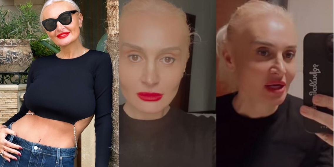 რა პროცედურა ჩაიტარა ნანუკა ჟორჟოლიანმა სახეზე ? – “შედეგი იქნება 10 დღეში”