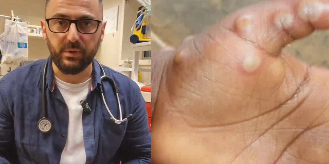 არსებობს თუ არა საქართველოში “მაიმუნის ყვავილის” გავრცელების საფრთხე? – რას ამბობს ექიმი არჩილ მარშანია