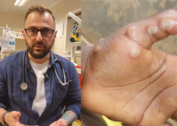 არსებობს თუ არა საქართველოში “მაიმუნის ყვავილის” გავრცელების საფრთხე? – რას ამბობს ექიმი არჩილ მარშანია