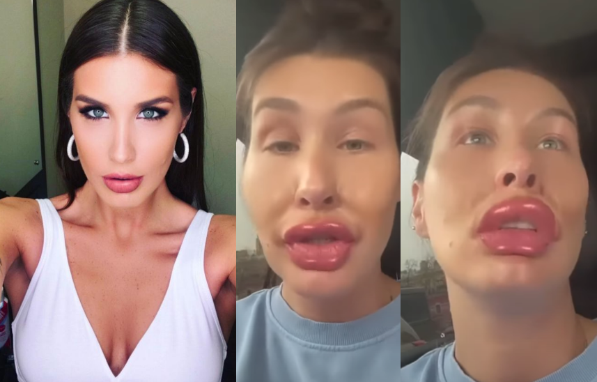 ”ცოტა ფილერი გავიკეთე სახეზე და ტუჩზე” – რა ვიდეოს აქვეყნებს ქეთა თოფურია ?