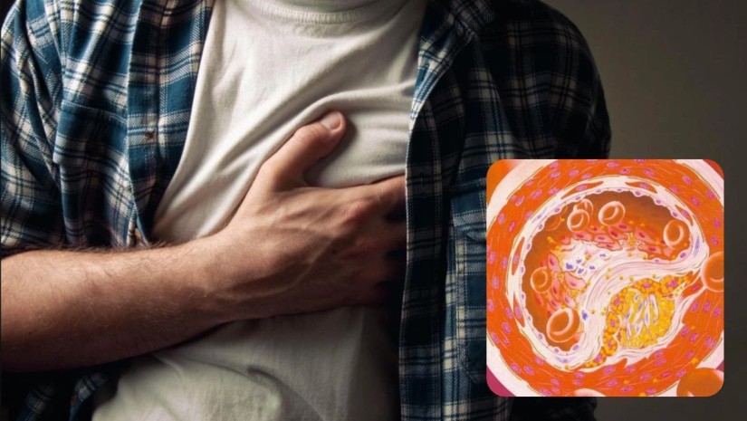 დადგენილია სიმპტომები, რომელიც ინფარქტამდე, ან ინსულტამდე რამდენიმე წლით ადრე ვლინდება – კვლევა