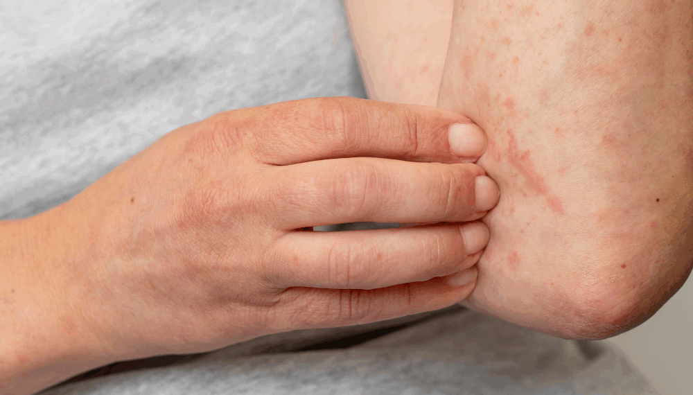 მუნის სამკურნალო ხალხური მეთოდები – მალამოს მომზადება სახლში, მარტივად შეგიძლიათ