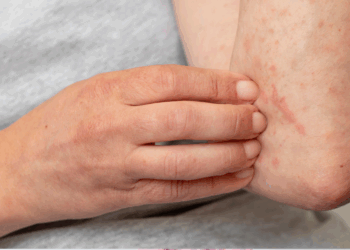 მუნის სამკურნალო ხალხური მეთოდები – მალამოს მომზადება სახლში, მარტივად შეგიძლიათ